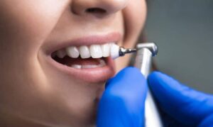 Dental Cleanings