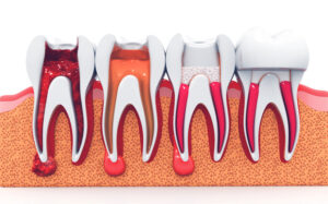 Root Canal
