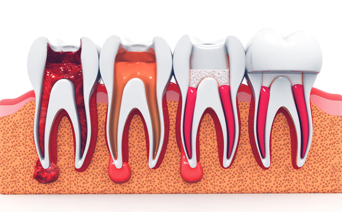 Root Canal